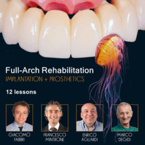Full-Arch Rehabilitation: Implantation and Prosthetics