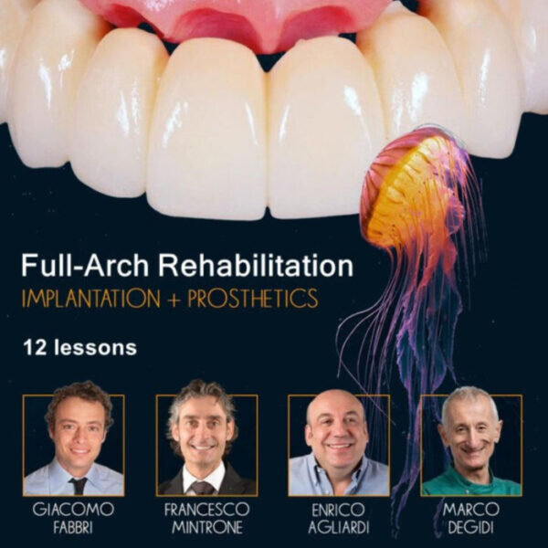 Full-Arch Rehabilitation: Implantation and Prosthetics