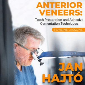 Anterior Veneer: Tooth Preparation and Adhesive Cementation Techniques